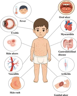 New Tiered Framework Developed for Categorizing Behçet's Spectrum Disorders in Pediatric Patients