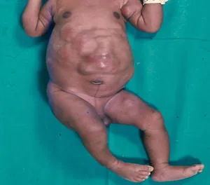 Risk-guided care reshapes childhood neuroblastoma treatment